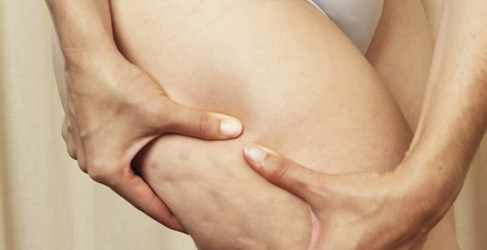 Cellulite Treatment Harrogate